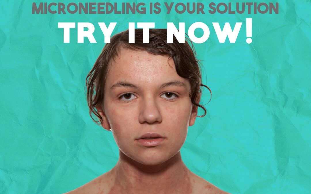 is-microneedling-at-home-dangerous?-what-you-need-to-know