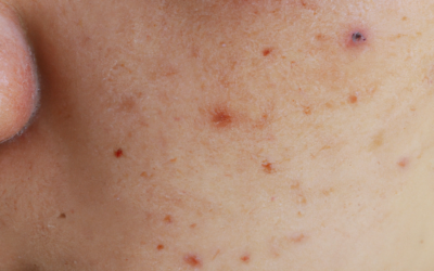 Acne Scarring: Causes and Prevention Strategies