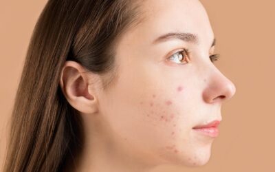 What is Acne Vulgaris