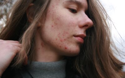 Where Does Cystic Acne Come From