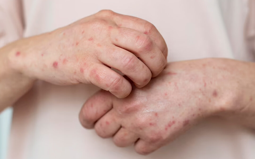 skin-health:-here-are-5-infections-that-can-seriously-damage-skin