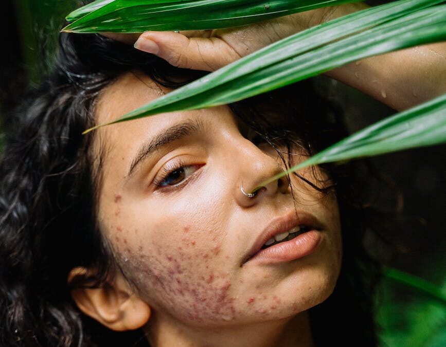 Understanding the Causes of Acne Breakouts