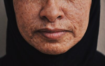 Are There Home Remedies For Acne Scars?