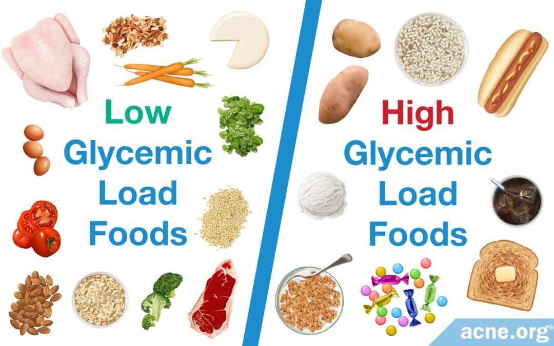 glycemic-load-diet-and-acne