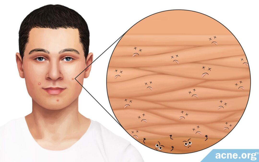 acne-in-depth:-how-dead-skin-cell-accumulation-can-lead-to-acne