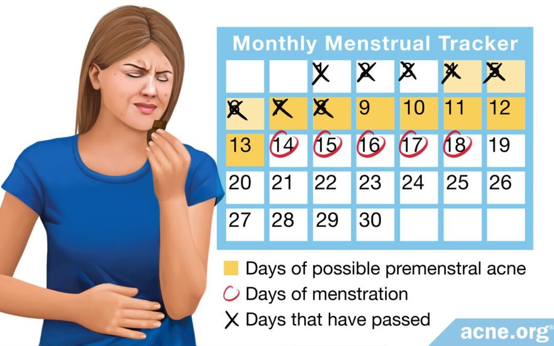 premenstrual-acne