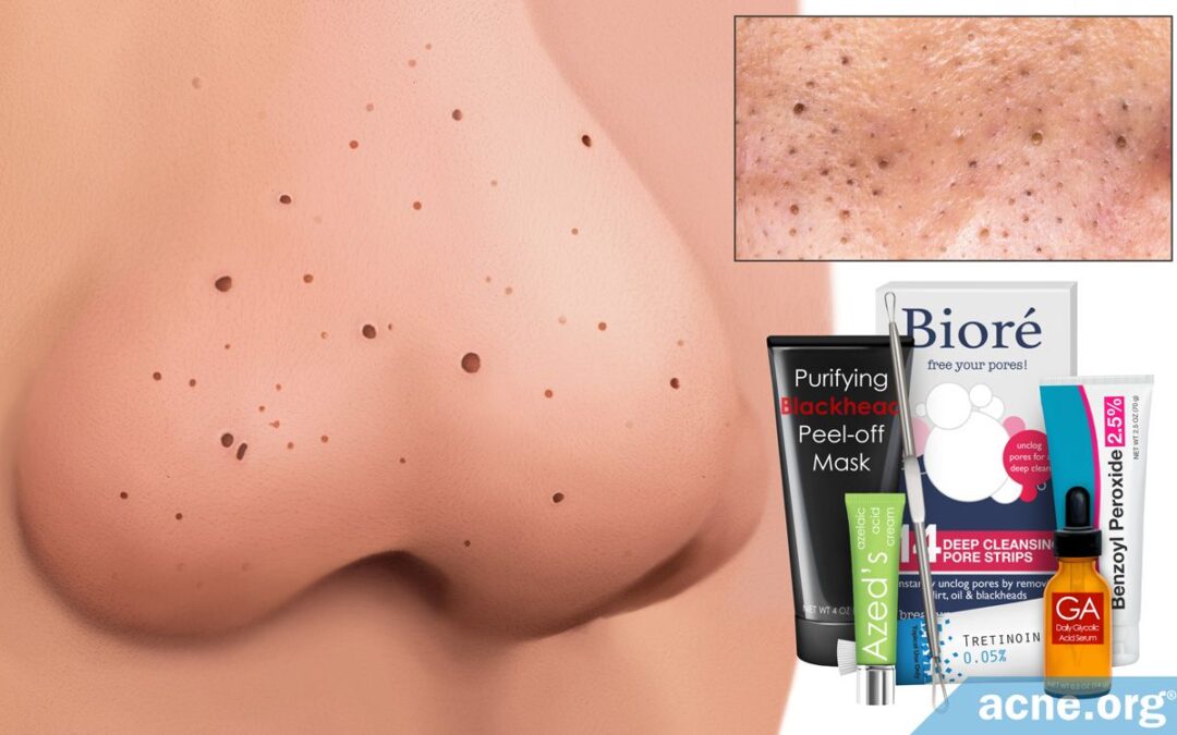 How to Clear Open Comedones (Blackheads)