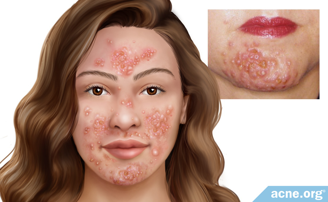 What Is Pyoderma Faciale?
