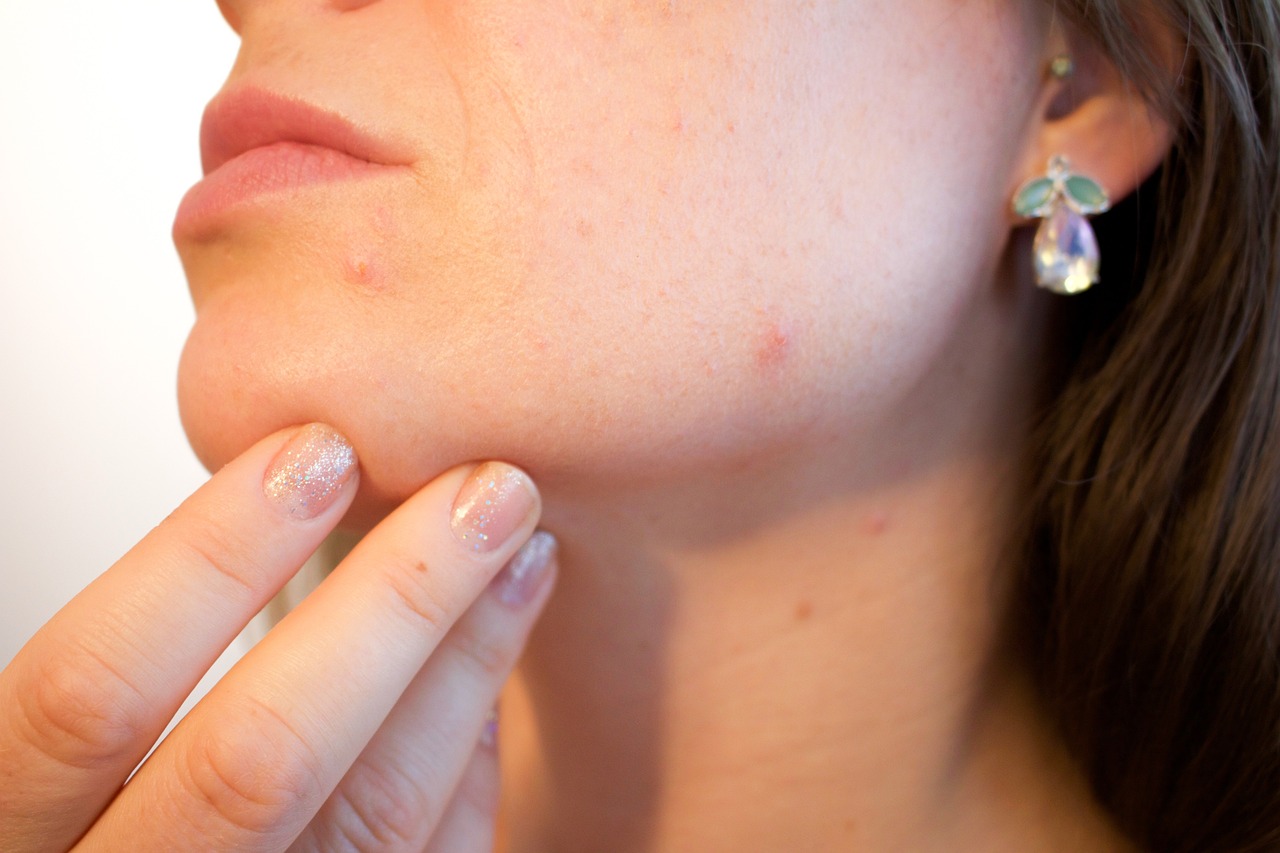 What Foods Cause Hormonal Acne?