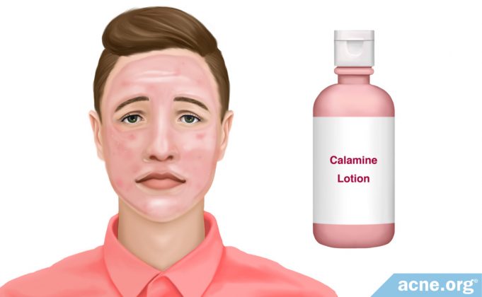 does-calamine-lotion-clear-acne?