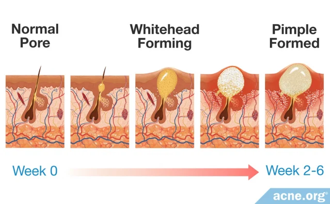 how-long-does-it-take-for-a-pimple-to-form?