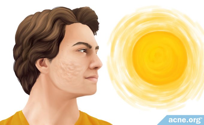 does-sun-exposure-make-acne-scars-worse?