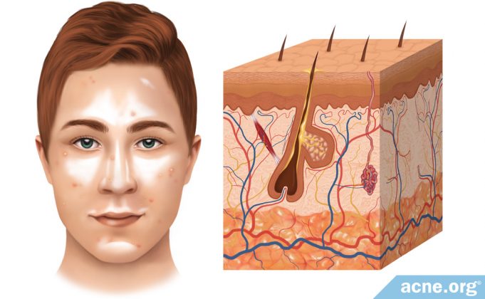 the-role-of-sebum-(skin-oil)-in-acne