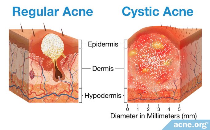 regular-acne-vs.-cystic-acne:-what’s-the-difference?