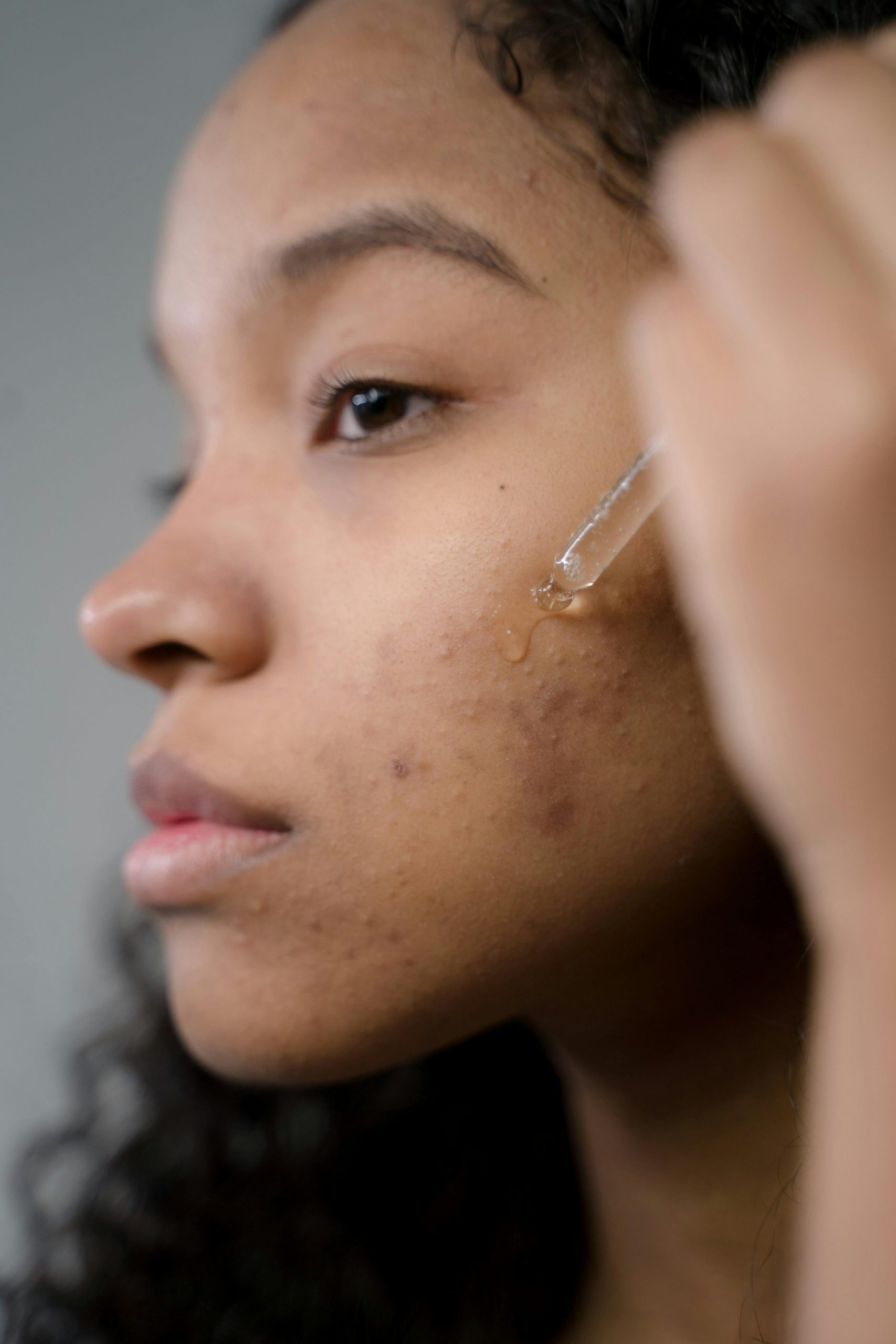 The Role Of Hydration In Preventing Acne Breakouts