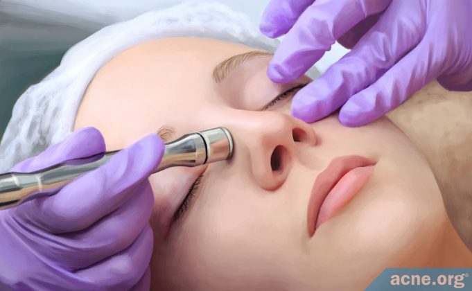 does-microdermabrasion-improve-acne-or-make-acne-worse?