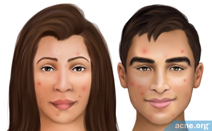 latino-skin-and-acne