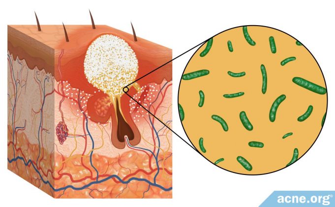 the-role-of-bacteria-in-acne