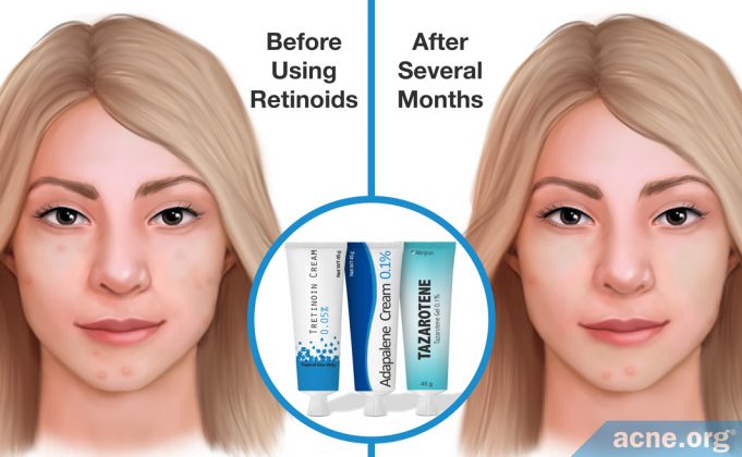 if-you-use-retinoids,-will-you-get-younger-looking-skin-as-you-treat-your-acne?