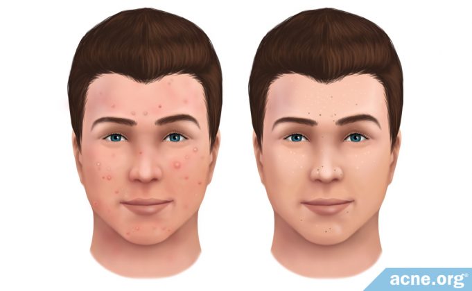 what-is-the-difference-between-inflamed-and-non-inflamed-acne?