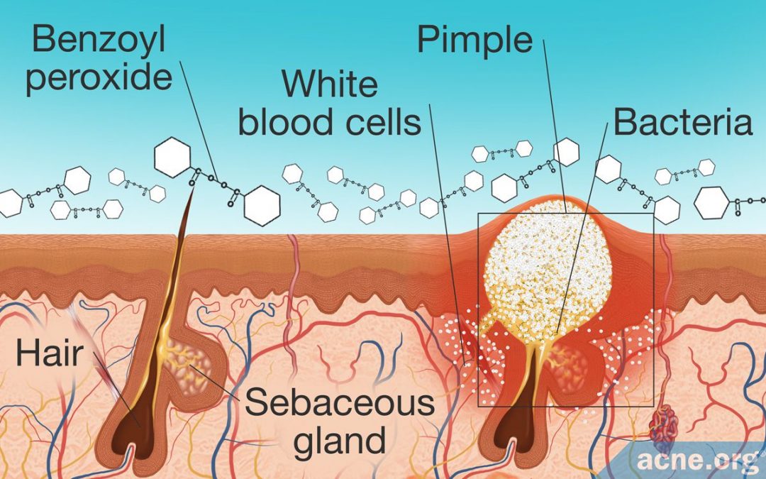 How Does Benzoyl Peroxide Work in the Skin?