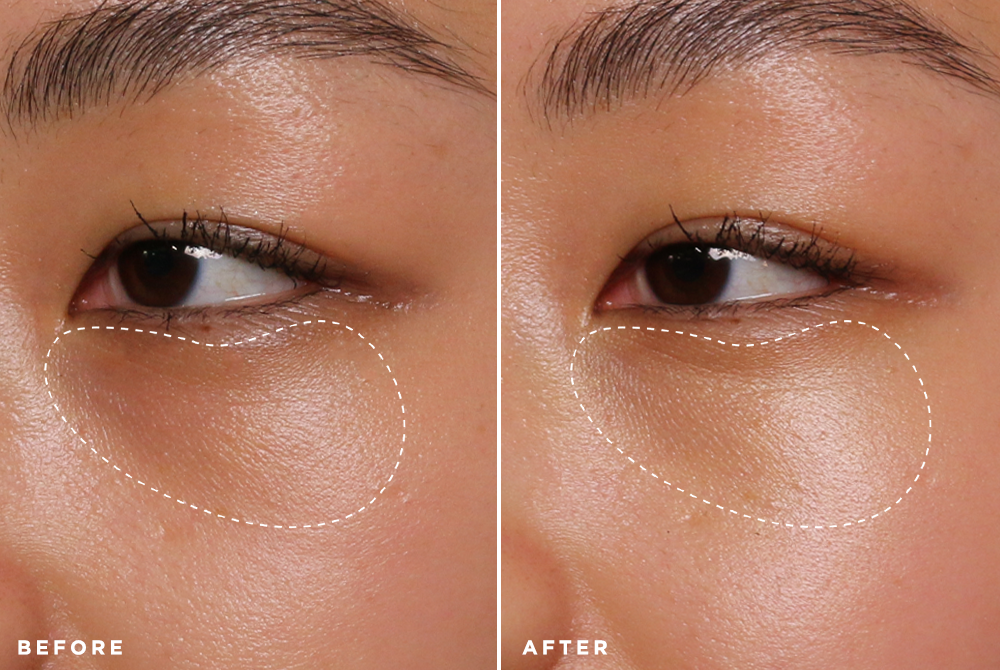 how-to-get-rid-of-dark-circles:-the-ultimate-dermatologist-approved-guide