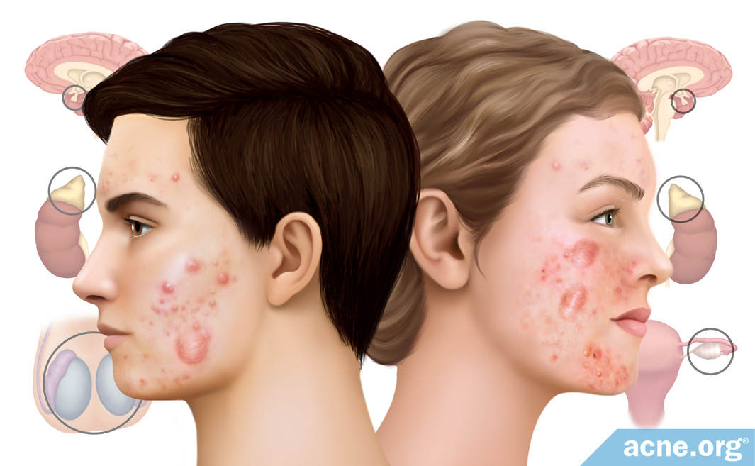 do-hormones-cause-cystic-acne?