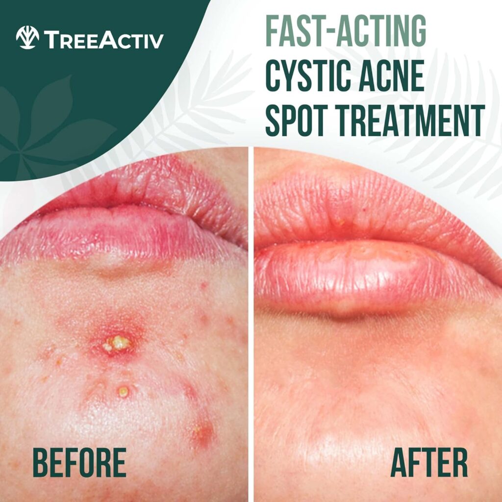 treeactiv cystic acne spot treatment