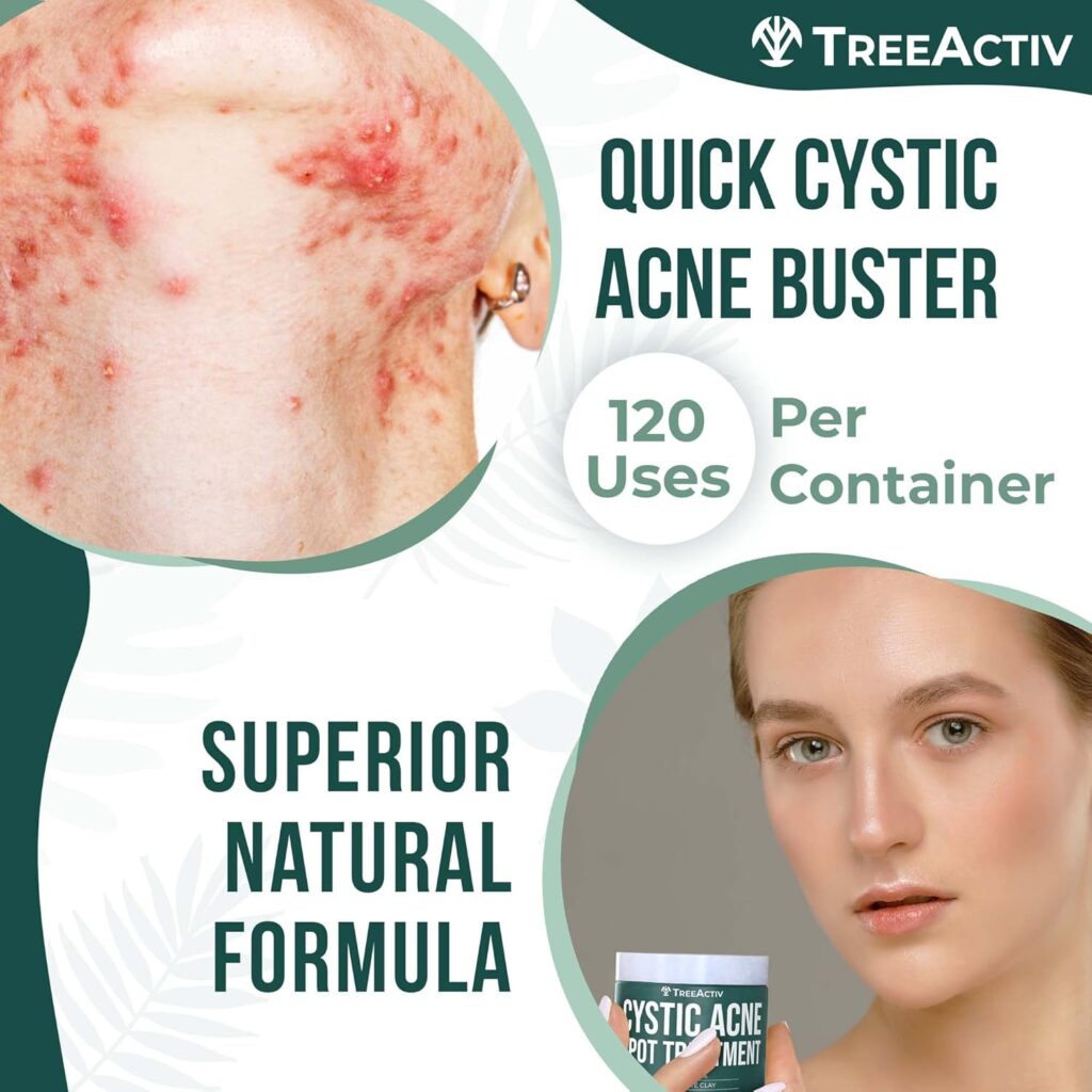 treeactiv cystic acne spot treatment